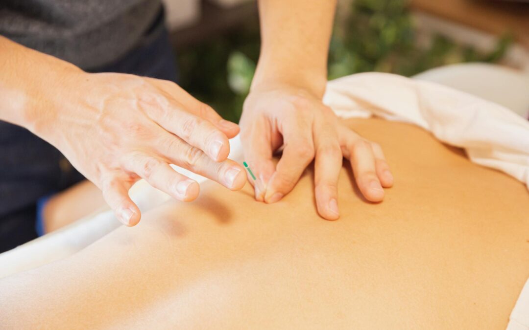 A practitioner inserting a fine acupuncture needle into a person's back during a treatment session.