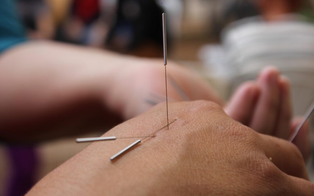 Acupuncture needles inserted into a person's hand for traditional Chinese medicine treatment.