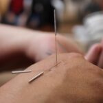 Acupuncture needles inserted into a person's hand for traditional Chinese medicine treatment.