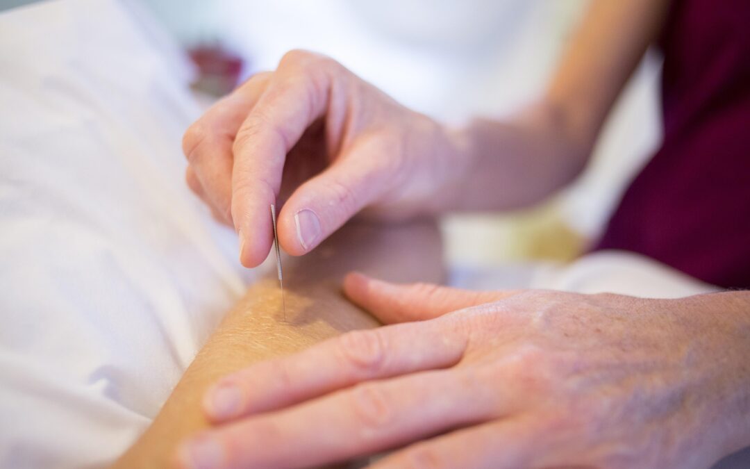 A close-up of an acupuncturist inserting a thin, sterile acupuncture needle into a patient's forearm during a treatment session.