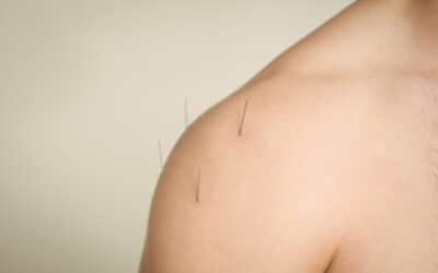 Acupuncture: Back Pain Relief