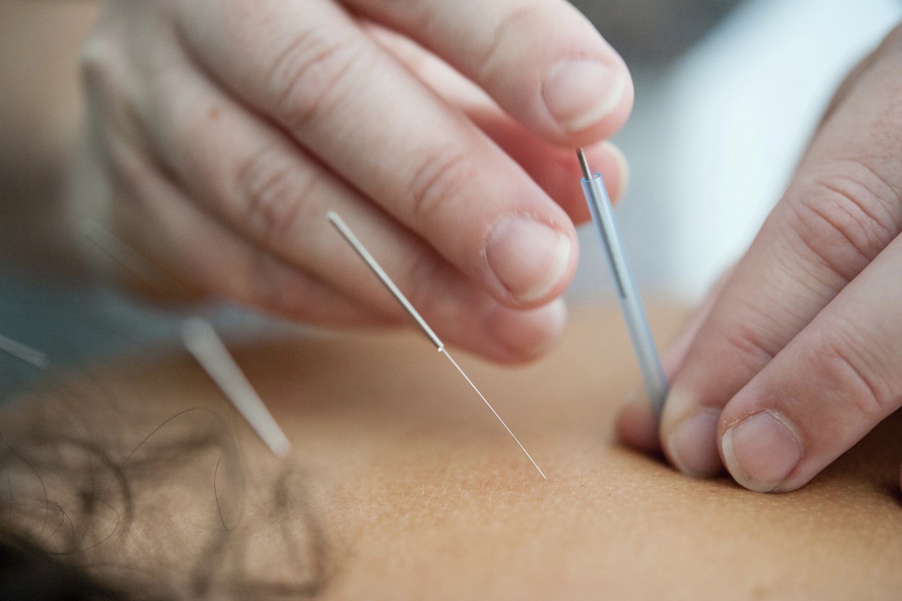 Acupuncture treatment at London Holistic Health Clinic with thin needles inserted into the skin.