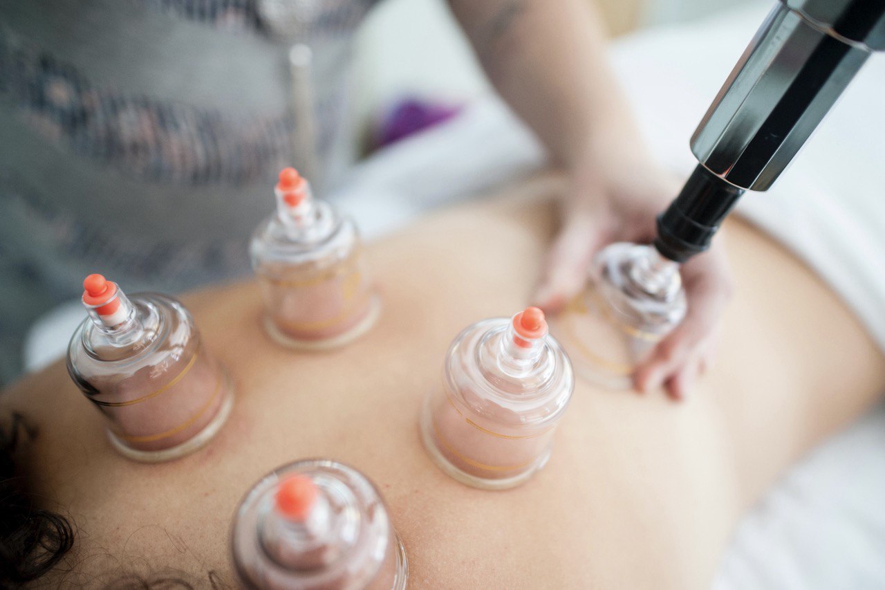 Cupping therapy session at London Holistic Health Clinic with suction cups placed on a patient's back.